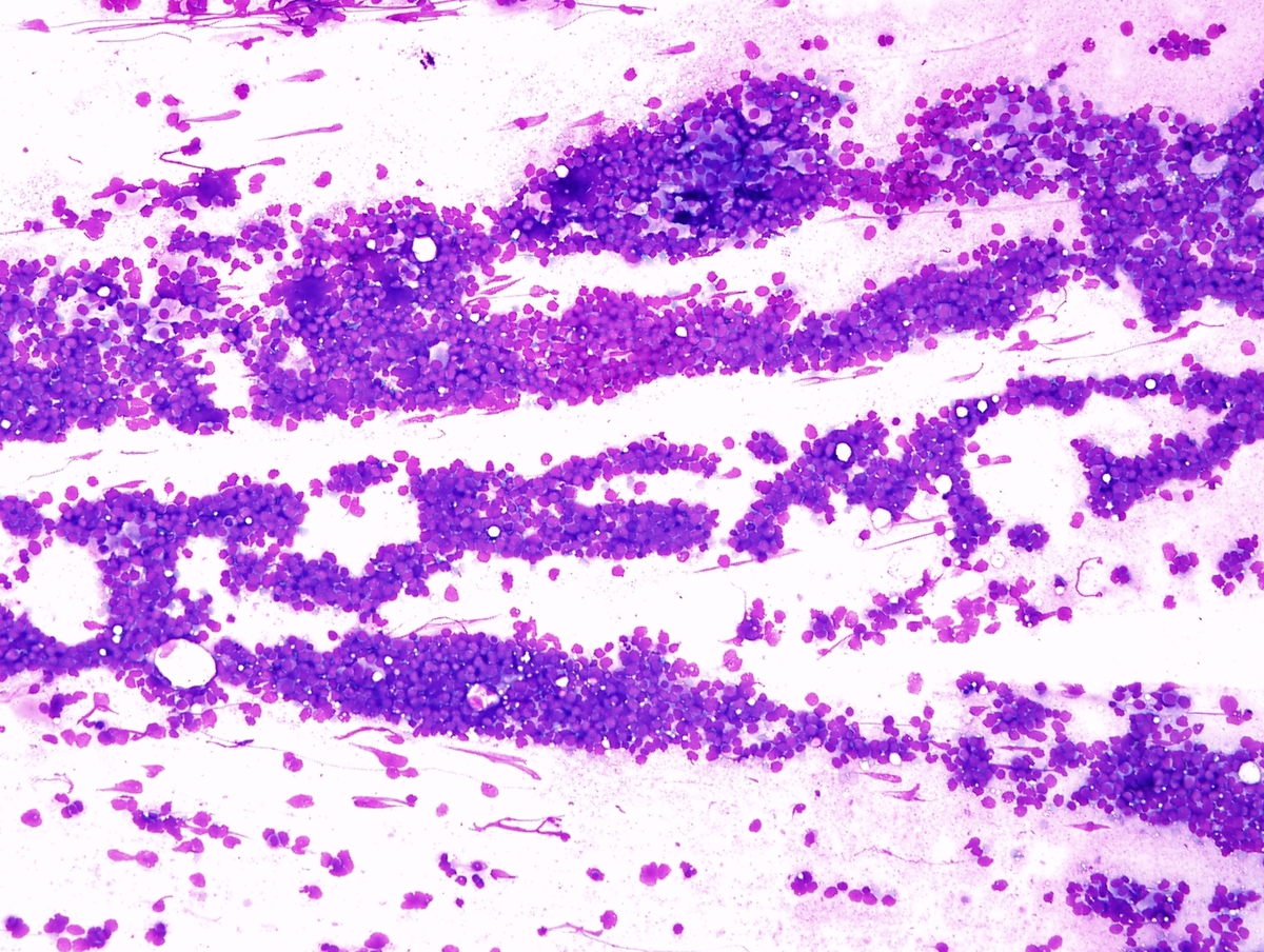 Intraoperative cytology, low power